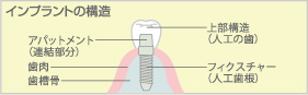 インプラントの構造
