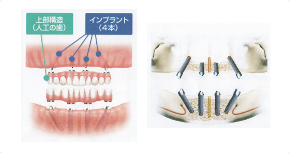 インプラント