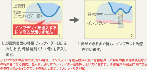 サイナスリフト法（上顎洞底挙上術）